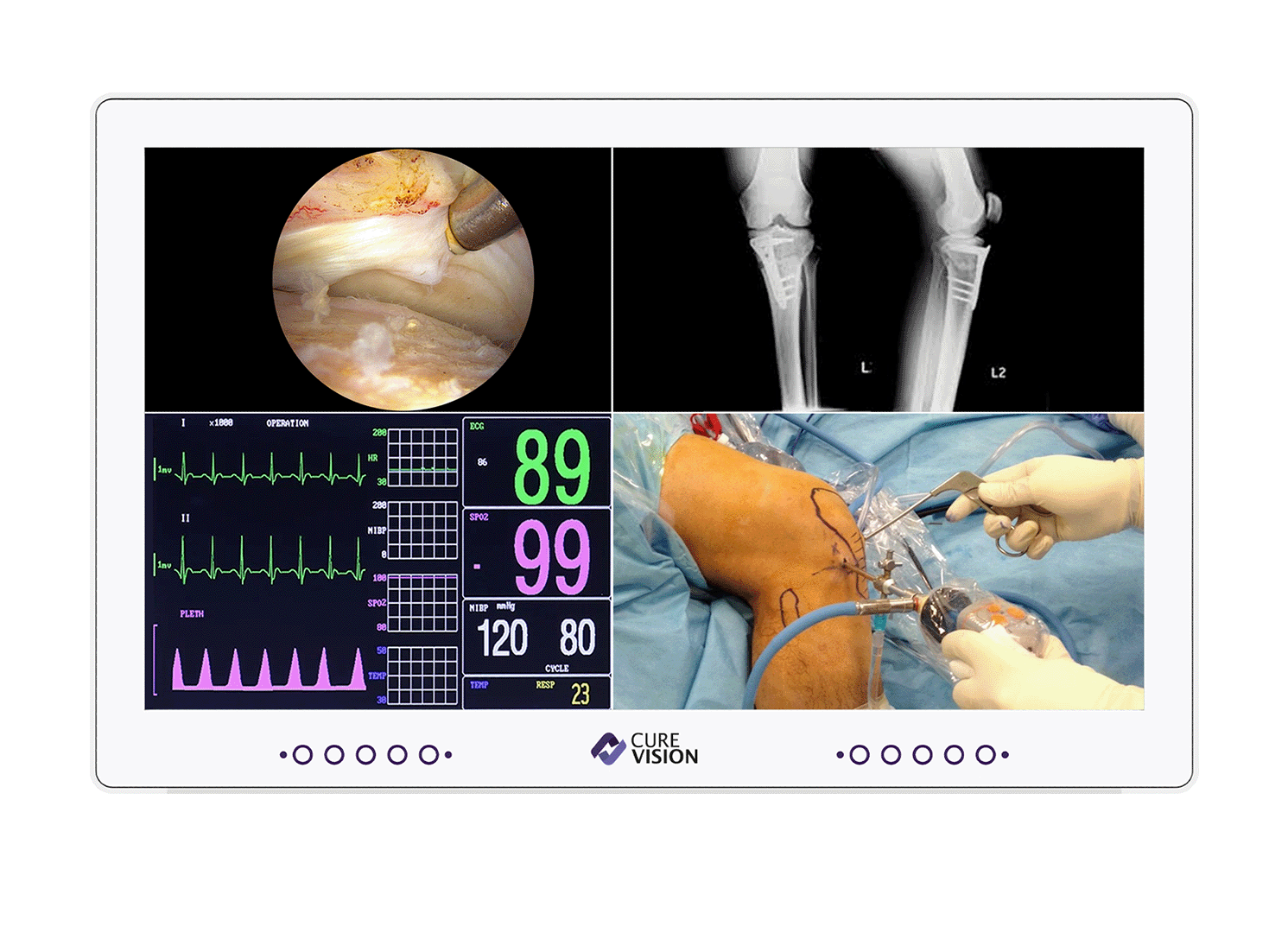 OR Integration System - Surgical Monitor